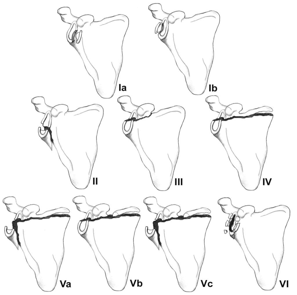 Scapula-Fractures-1024x1019.jpeg