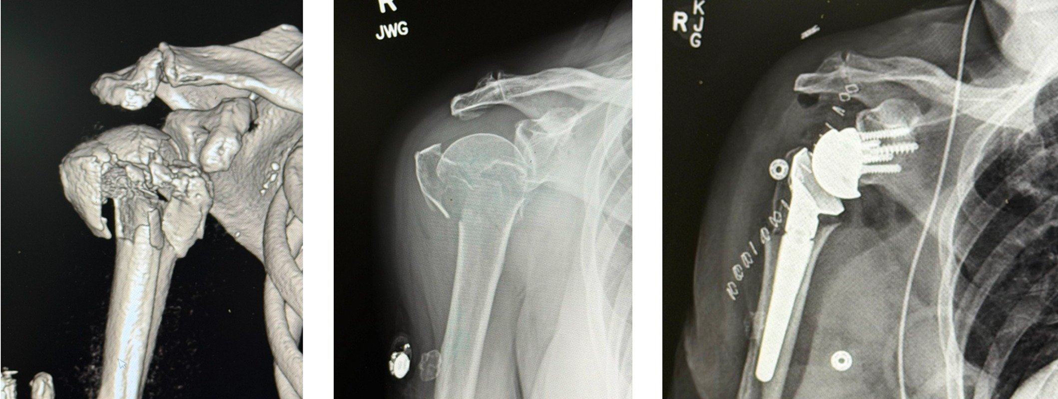 Shoulder_Replacement_9yiof0R.jpeg