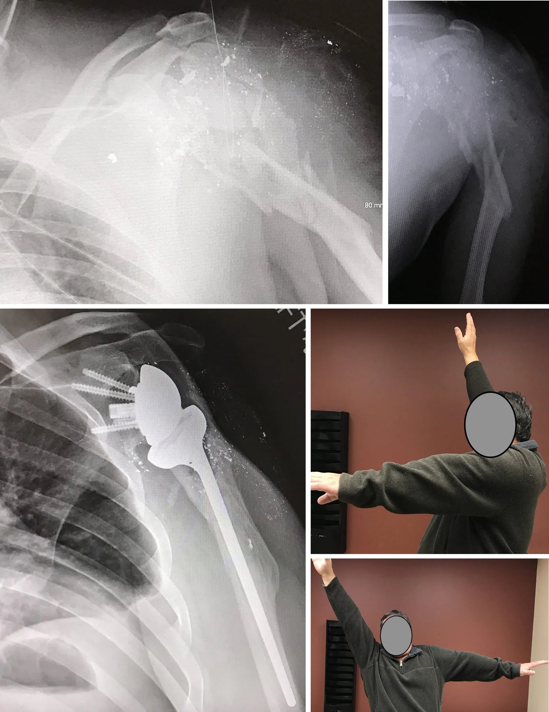 Shoulder_case.jpeg