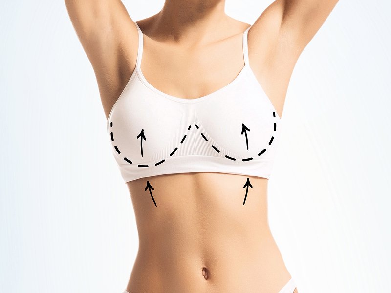 Breast Reduction