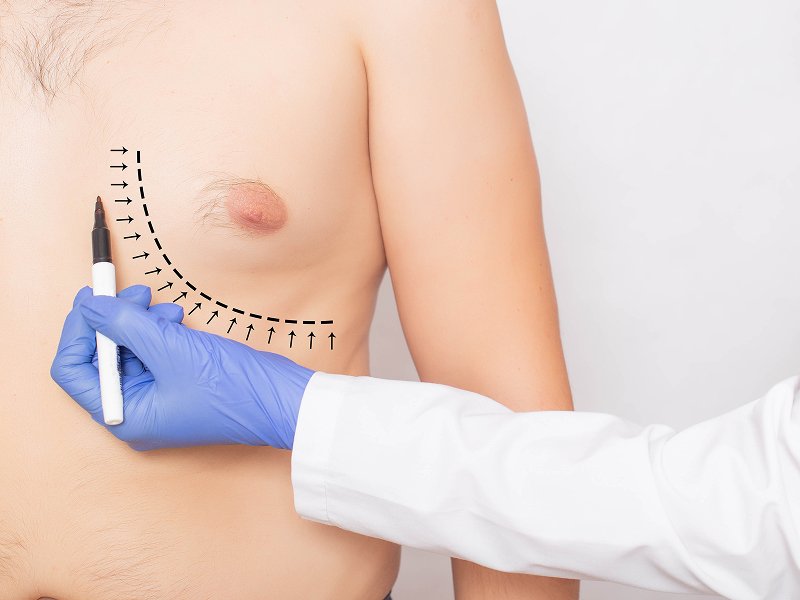 Gynecomastia Surgery