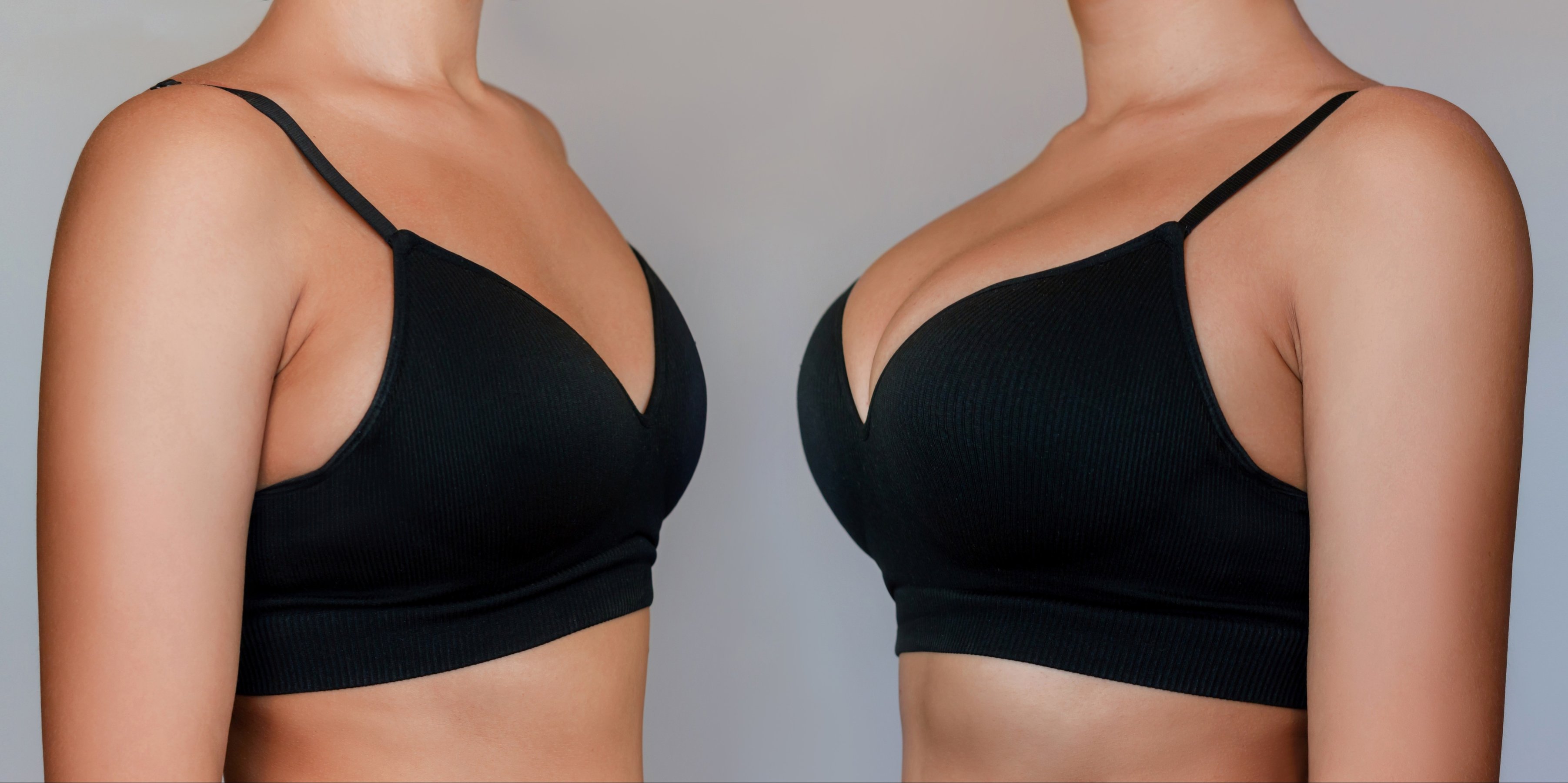 woman in black bra before and after breast augmentation with silicone implants
