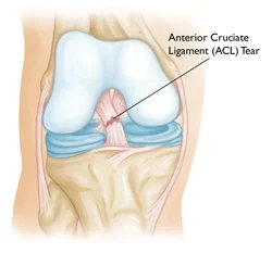 ACL_Reconstruction_lORHhcV.jpeg