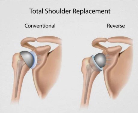 Reverse_Shoulder_Replacement-1_9kPrAHF.jpeg