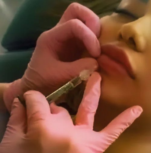 Lip Filler Injection 17