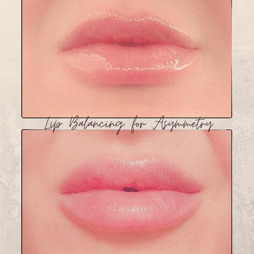 Lip filler balancing Before and After 12