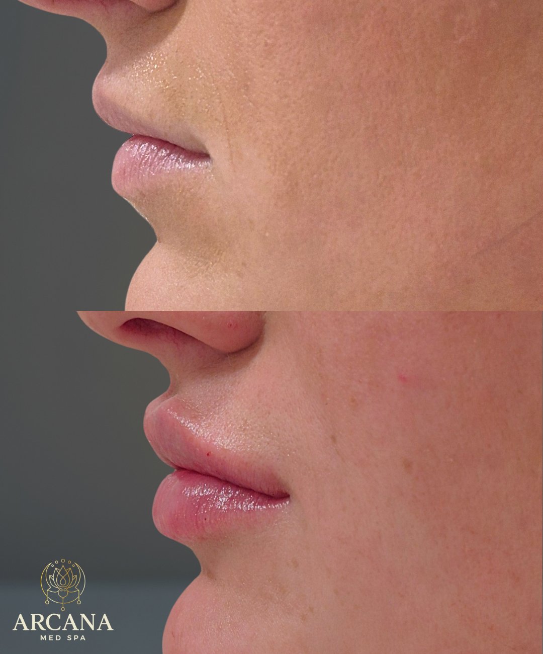 Lips Before and After 2