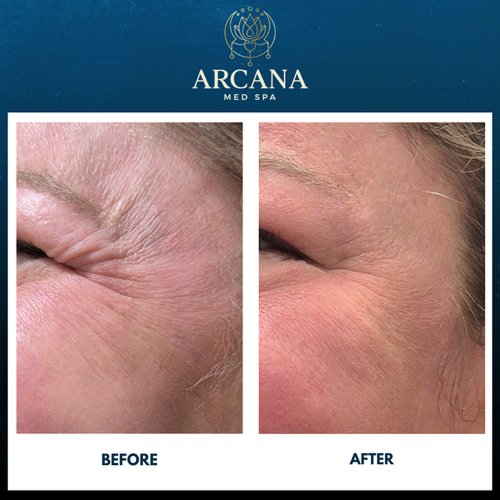 Botox crows Feet Before and After 28