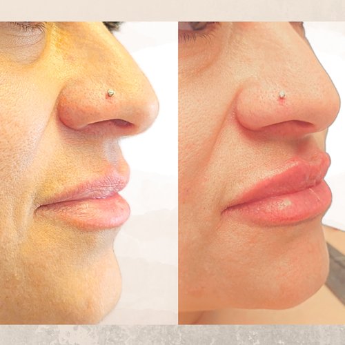 Dermal Filler for Lips Before and After 10