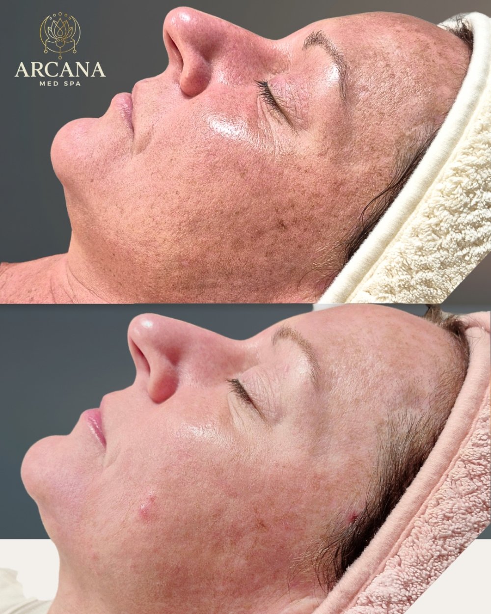 Dermal Filler for Lips BA