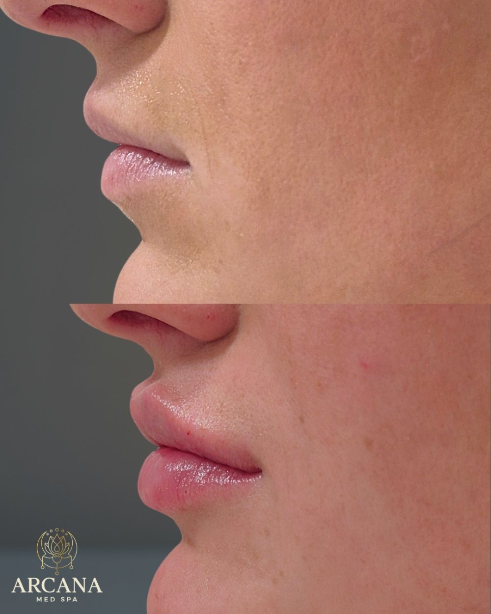 Botox Frown Lines BA