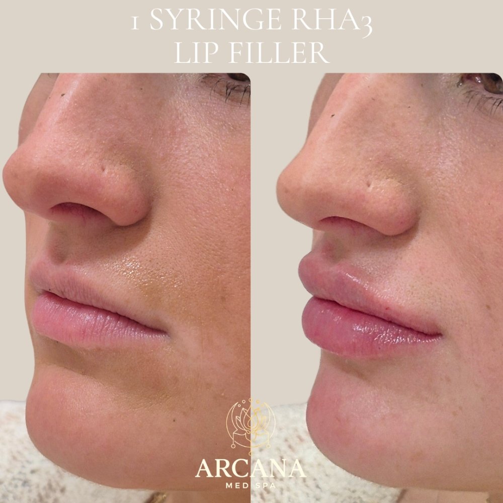 Facial Rejuvenation Before and After 9