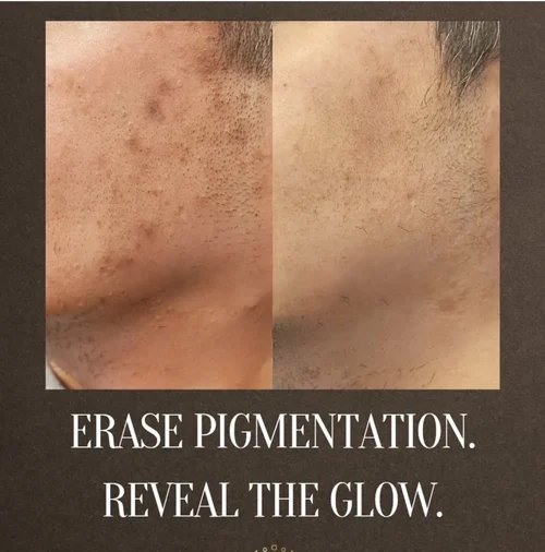 Pigmentation Treatment Before and After 18