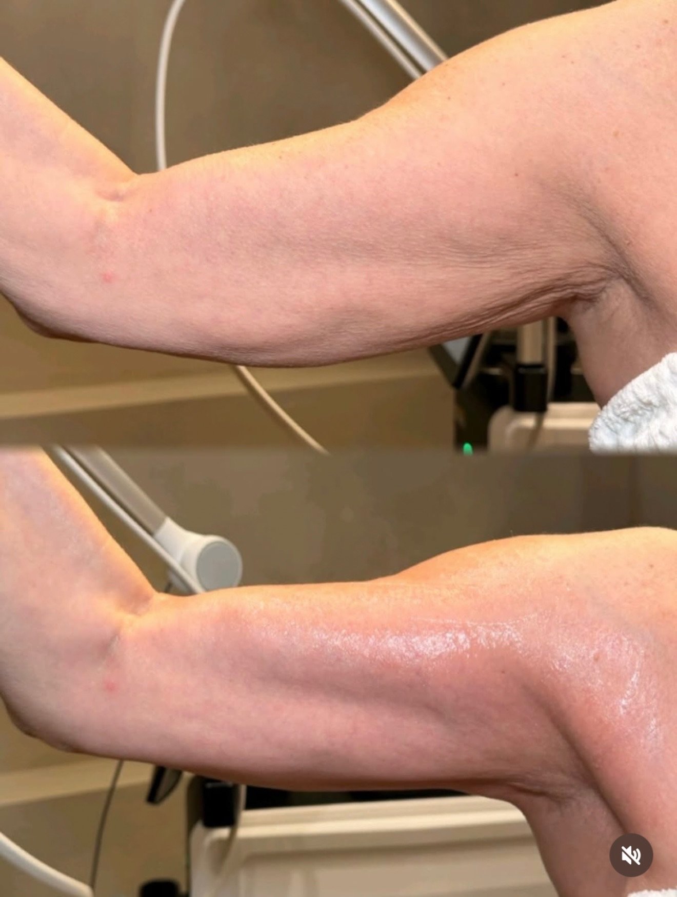 DIEP treatment before and after