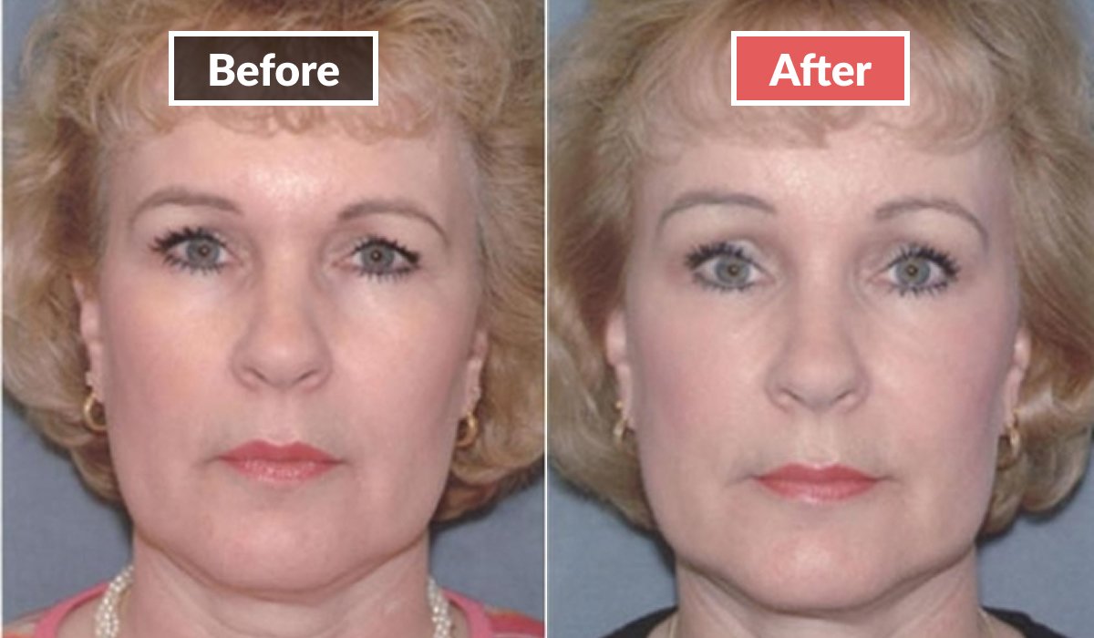 Brow Lift before and after