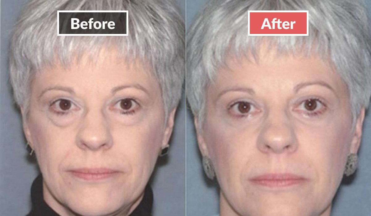 Eyelid Surgery before and after