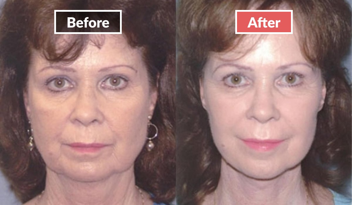 Face lift before and after