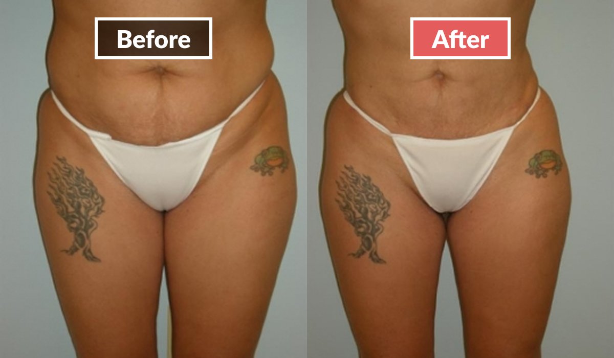 Liposuction before and after