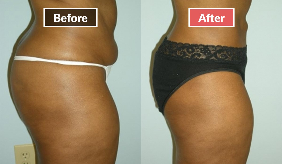 Liposuction before and after