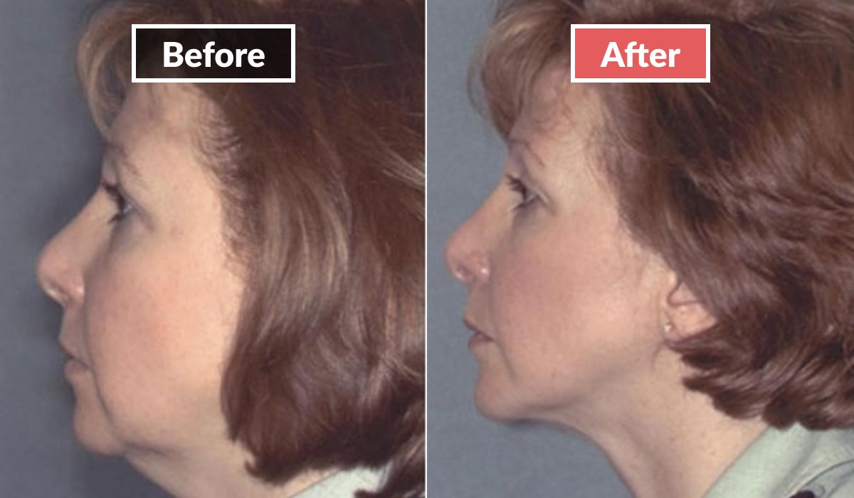 Neck Liposuction before and after