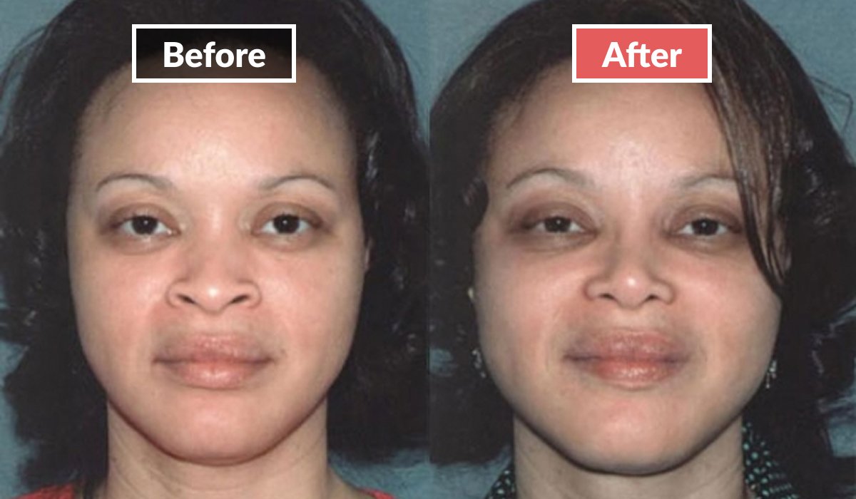 Rhinoplasty before and after