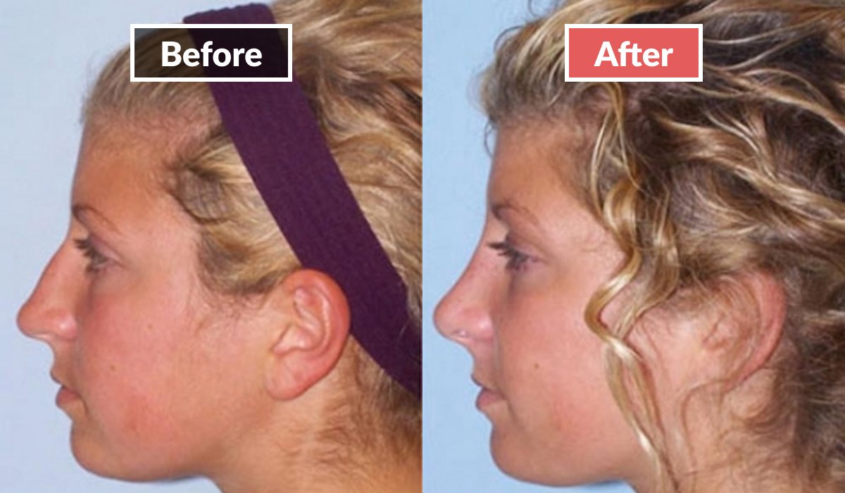 Rhinoplasty before and after
