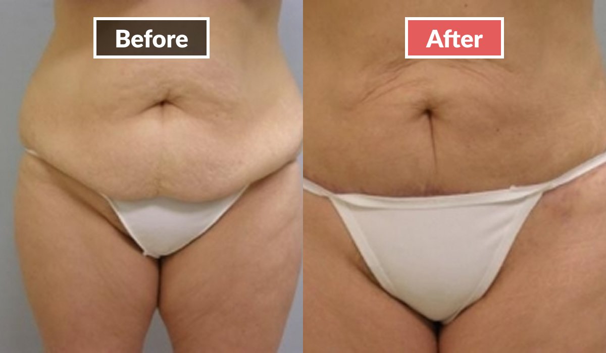 Tummy Tuck before and after