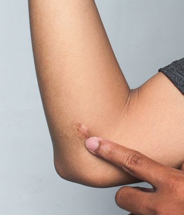 Keloid Removal
