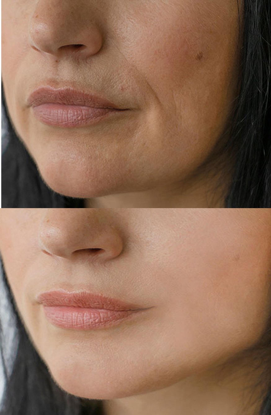 Morpheus8 Treatment