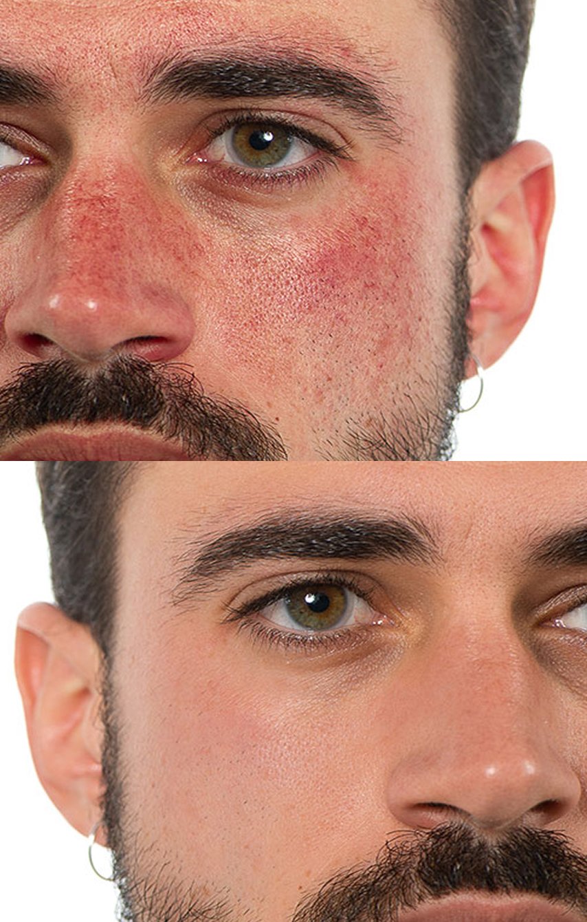 Face-skin-treatment