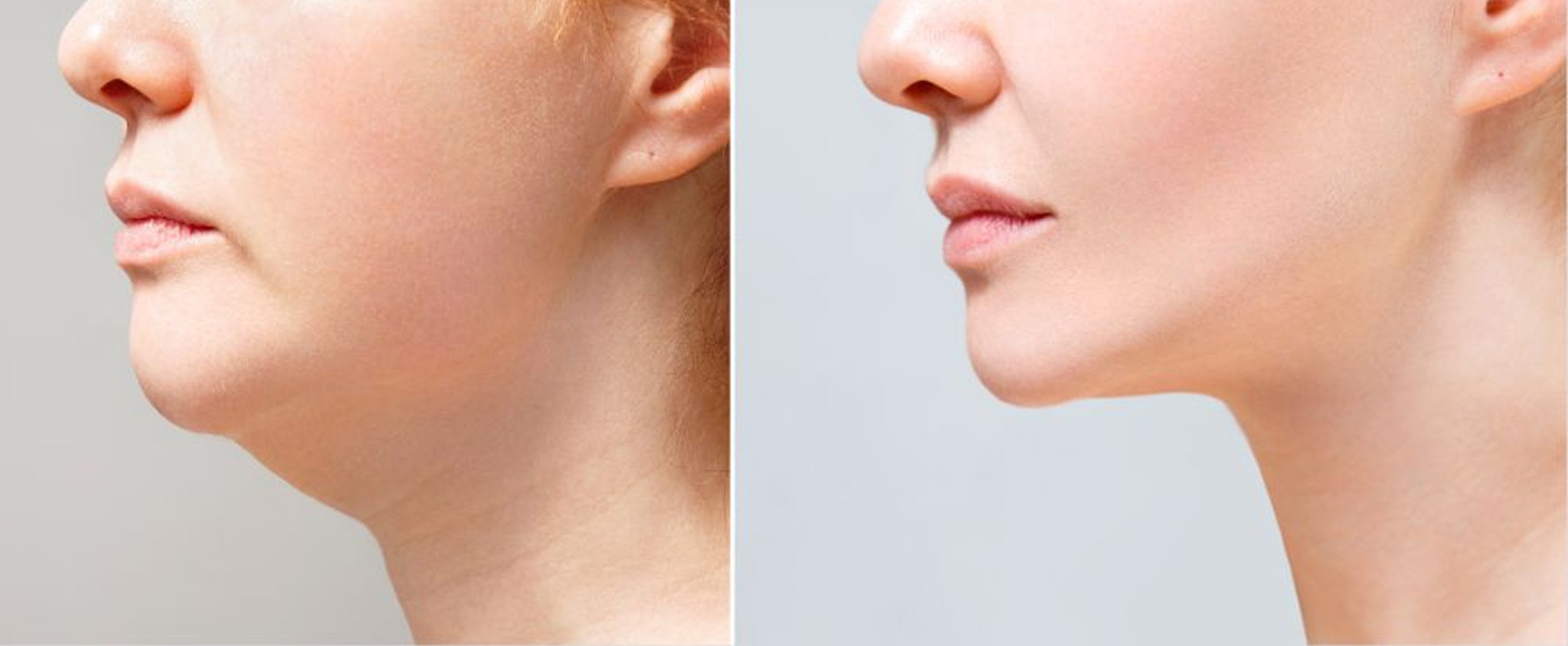 Morpheus8 Treatment