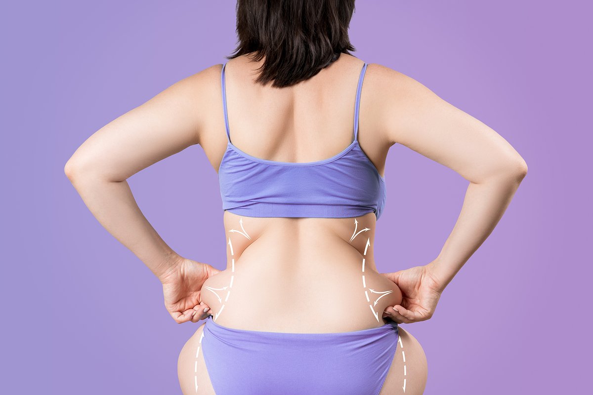 Back__Flank_Liposuction_jt5XfNi.jpeg