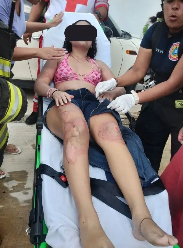 Mujer con heridas de fuego