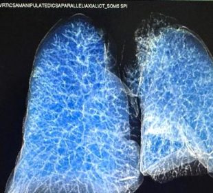 Pulmones de ser humano