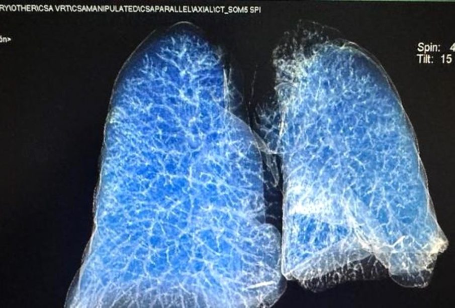 Pulmones de ser humano