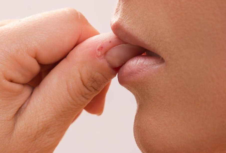 Las consecuencias de morderse las uñas; ¿cómo dejar de hacerlo?