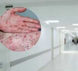 Hospital y sífilis