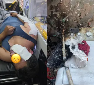 Hombre con quemaduras