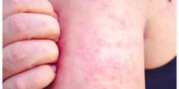 México registra 24 muertes y casi seis mil casos de sarampión