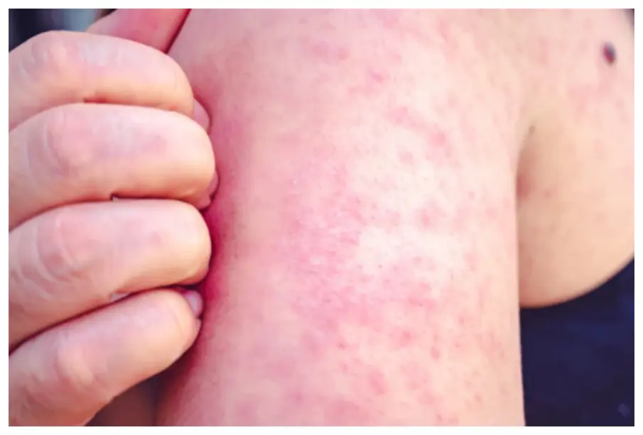 México registra 24 muertes y casi seis mil casos de sarampión