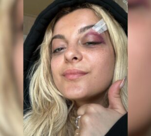 Bebe Rexha golpeada