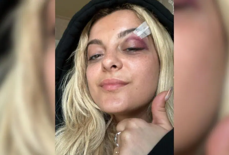 Bebe Rexha golpeada