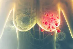 Células de cáncer de mama
