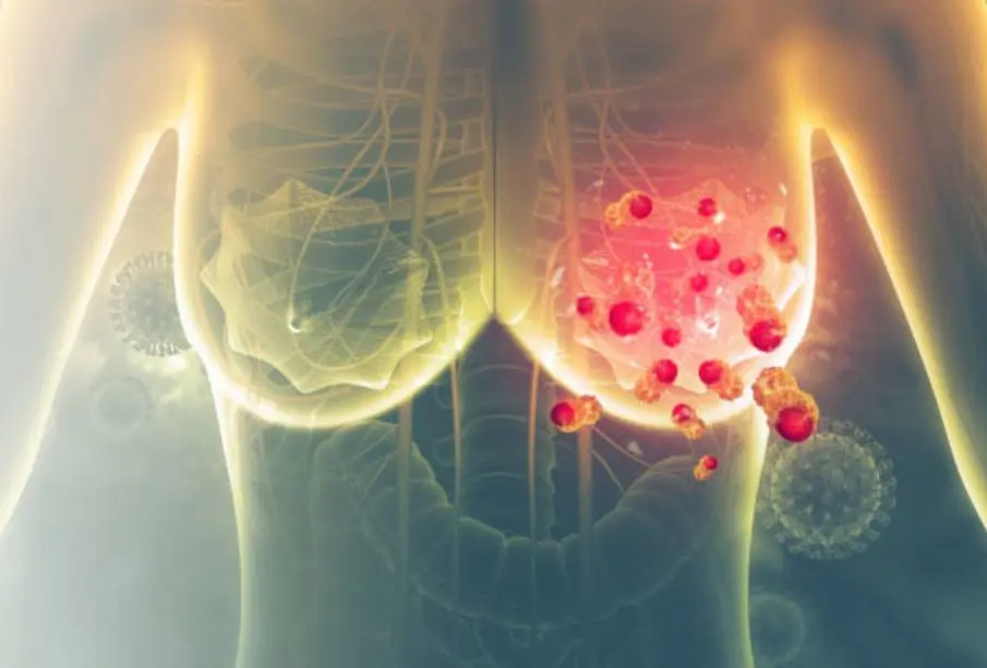 Células de cáncer de mama