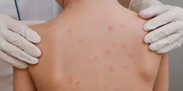 Sarampión: ¿cuántos casos hay en México en 2026?