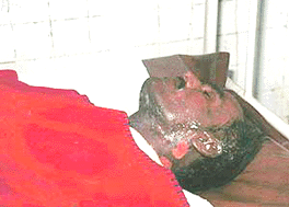 The 35 year old man, Mukesh Sharma, who reportedly tried to self-immolate himself in front of Delhi Chief Minister Shiela Dikshit's official residence opposite Pragati Maidan, in the heart of capital on Monday, lying in RML hospital with nearly 100 per cent burns