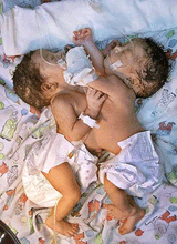 Baez conjoined twins