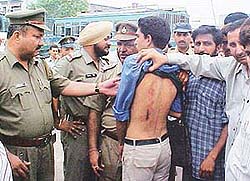 A private bus operator shows wounds which were allegedly inflicted on his bus driver by autorickshaw drivers in Ambala City.