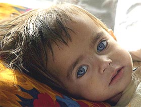 A malnourished Afghan girl lies in her bed 