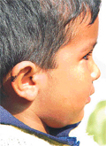 One-and-a-half-year-old Chaitanya with stitches on his right ear 